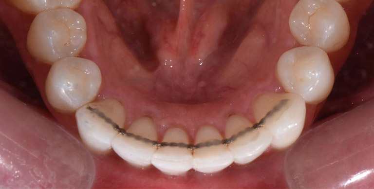 After - Crown Bank Dental