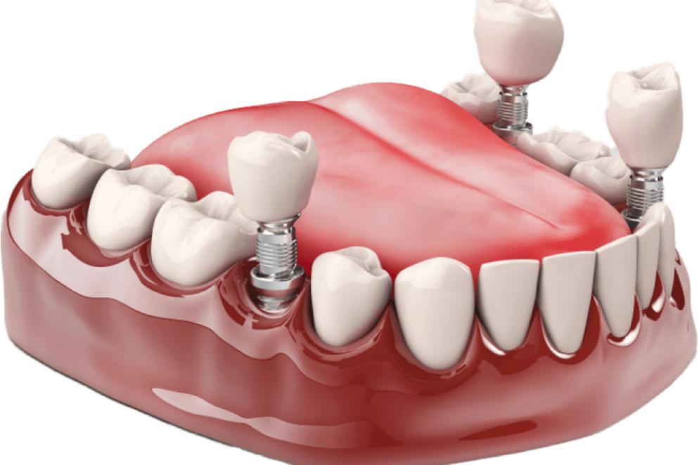 dental implants thumb1