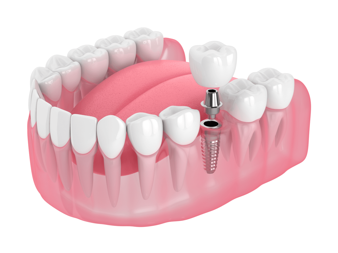 dental implants thumb2