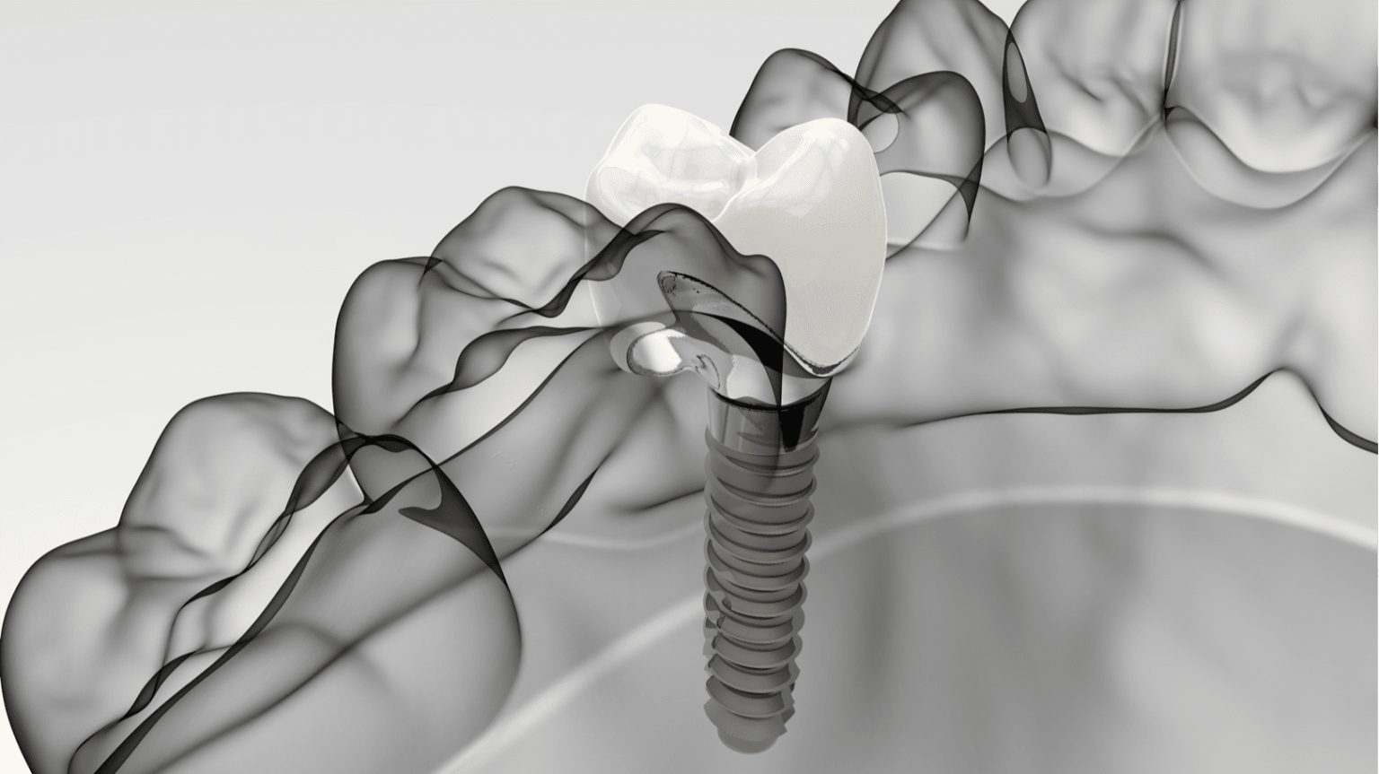 Sandbach Cheshire Dental Implants - Crown Bank Dental