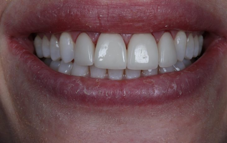 veneers treatment at crown bank dental after image