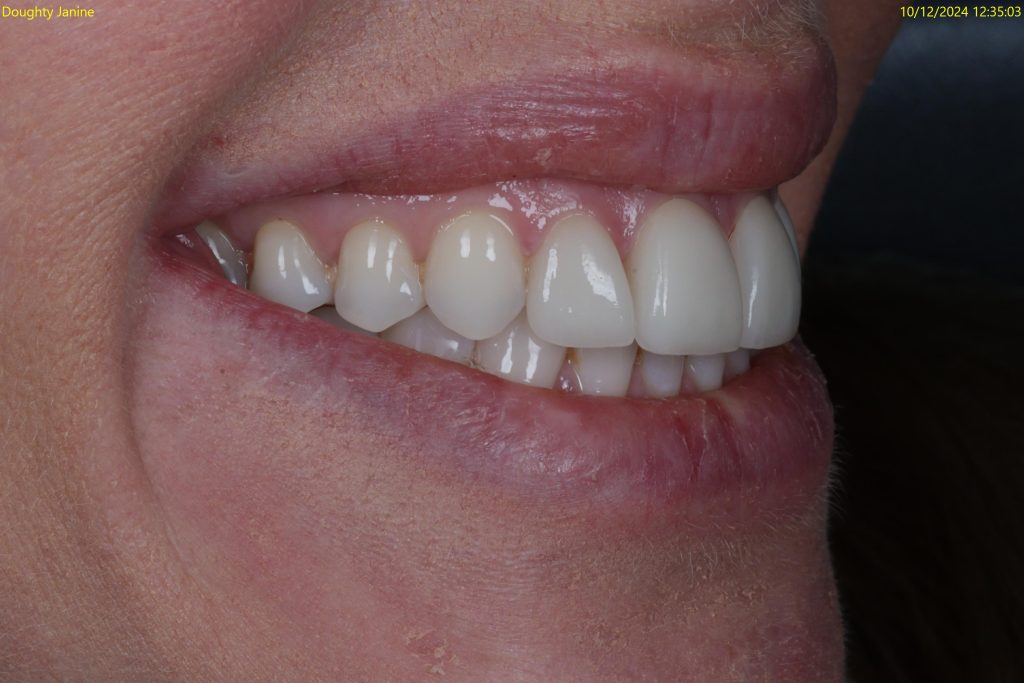 veneers treatment at crown bank dental after