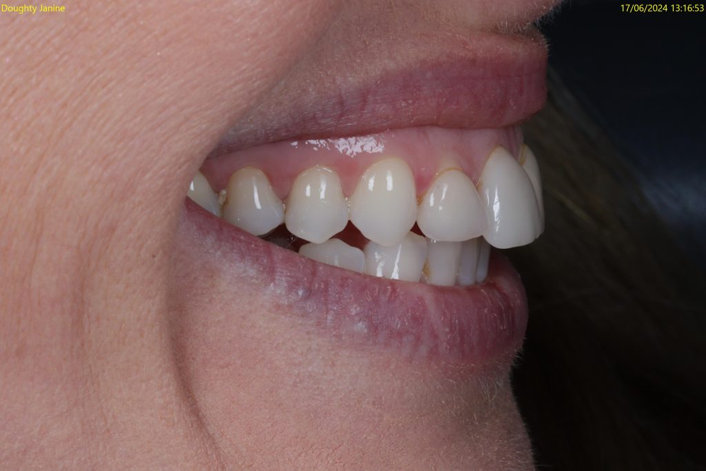 veneers treatment at crown bank dental before