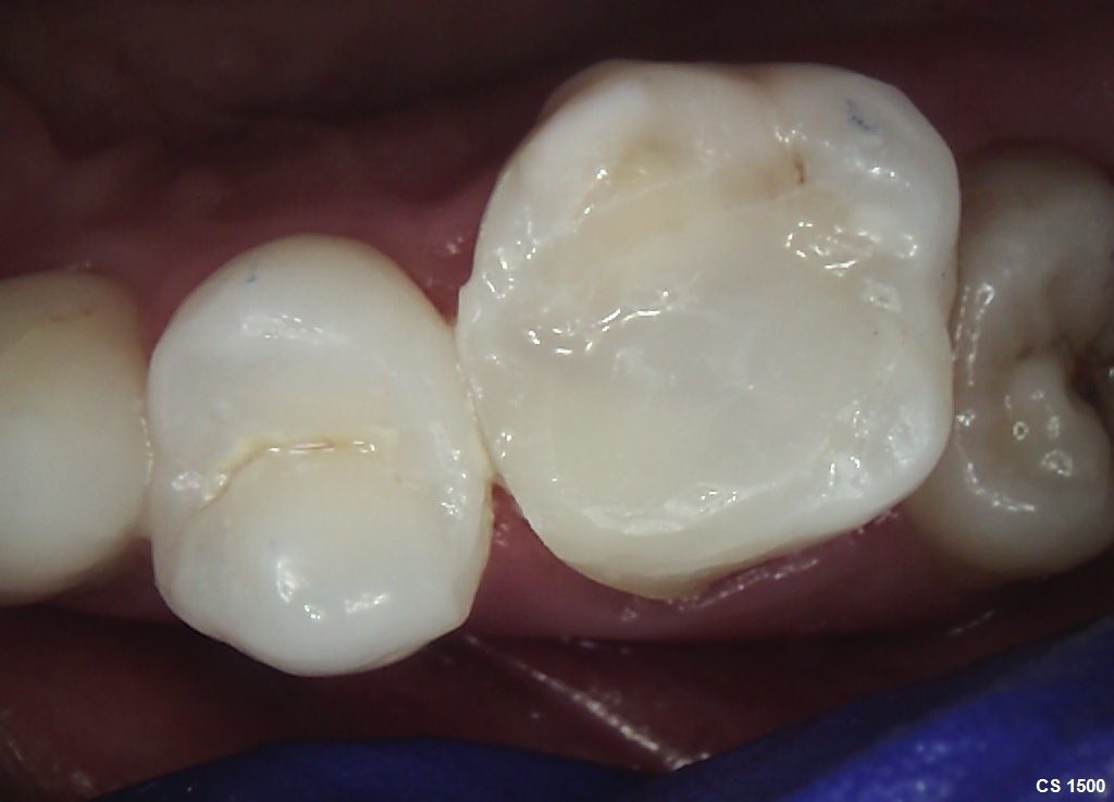 Root Canal Treatment - Crown Bank Dental After