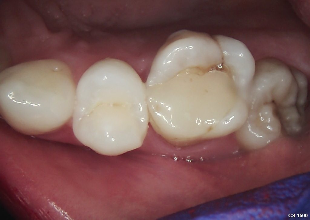 Root Canal Treatment - Crown Bank Dental Before