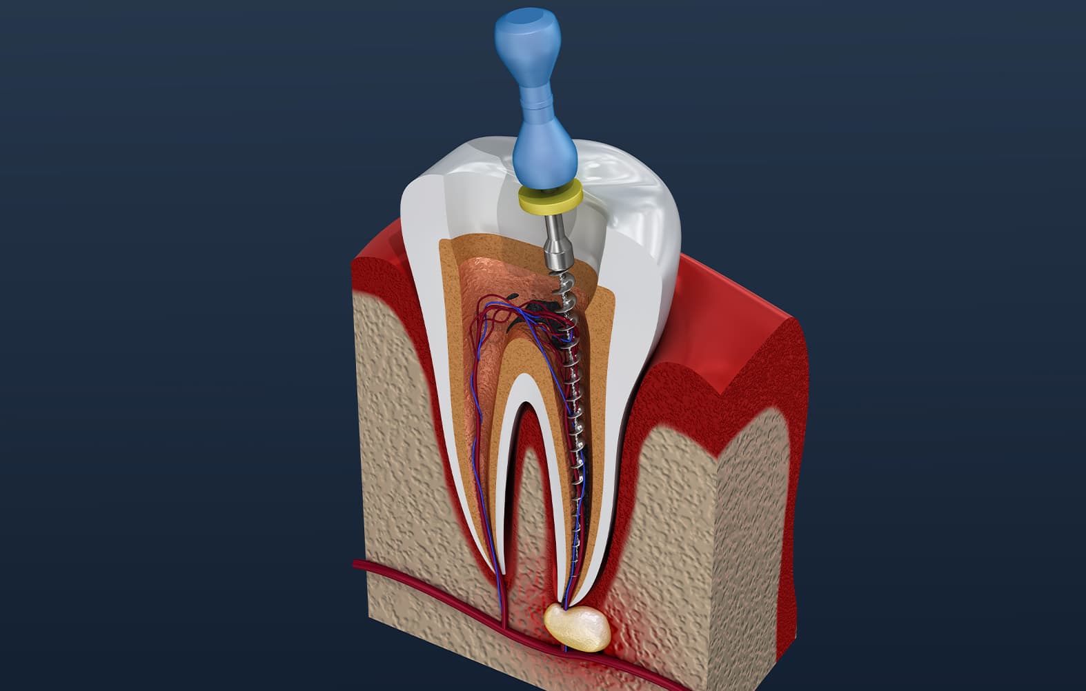 thumbnail image 2 of 36-Piece Dental Endodontic Root Canal Practice Teeth - RCT Study Model 2 of 5
