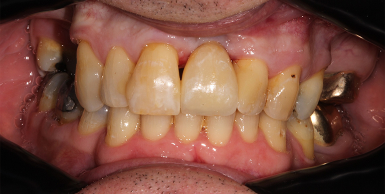 Before - Crown Bank Dental