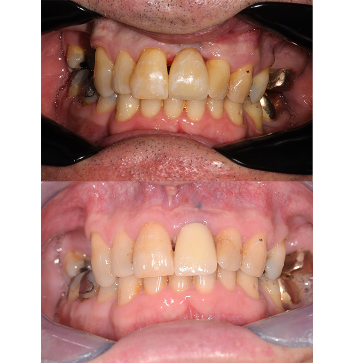 Smile Gallery - Crown Bank Dental