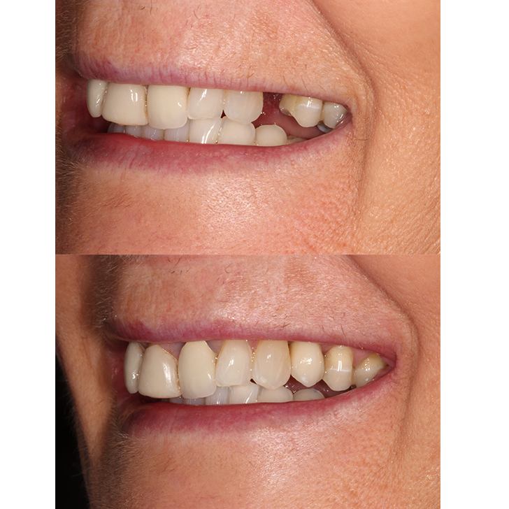 Smile Gallery - Crown Bank Dental