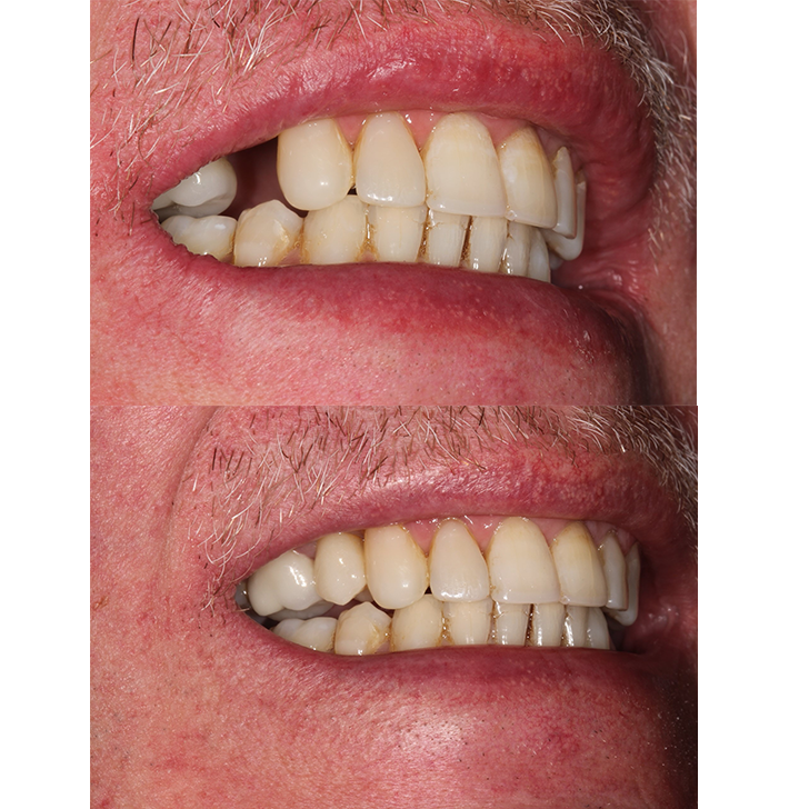 Smile Gallery - Crown Bank Dental
